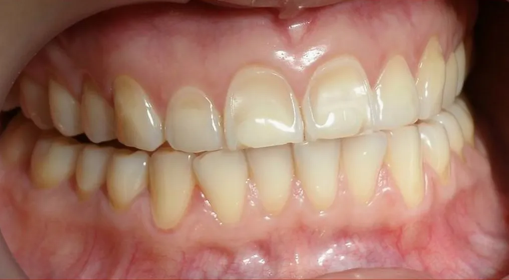 24718 baking soda lemon juice teeth whitening 1