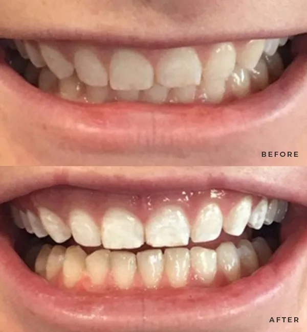 24719 smile lab before after