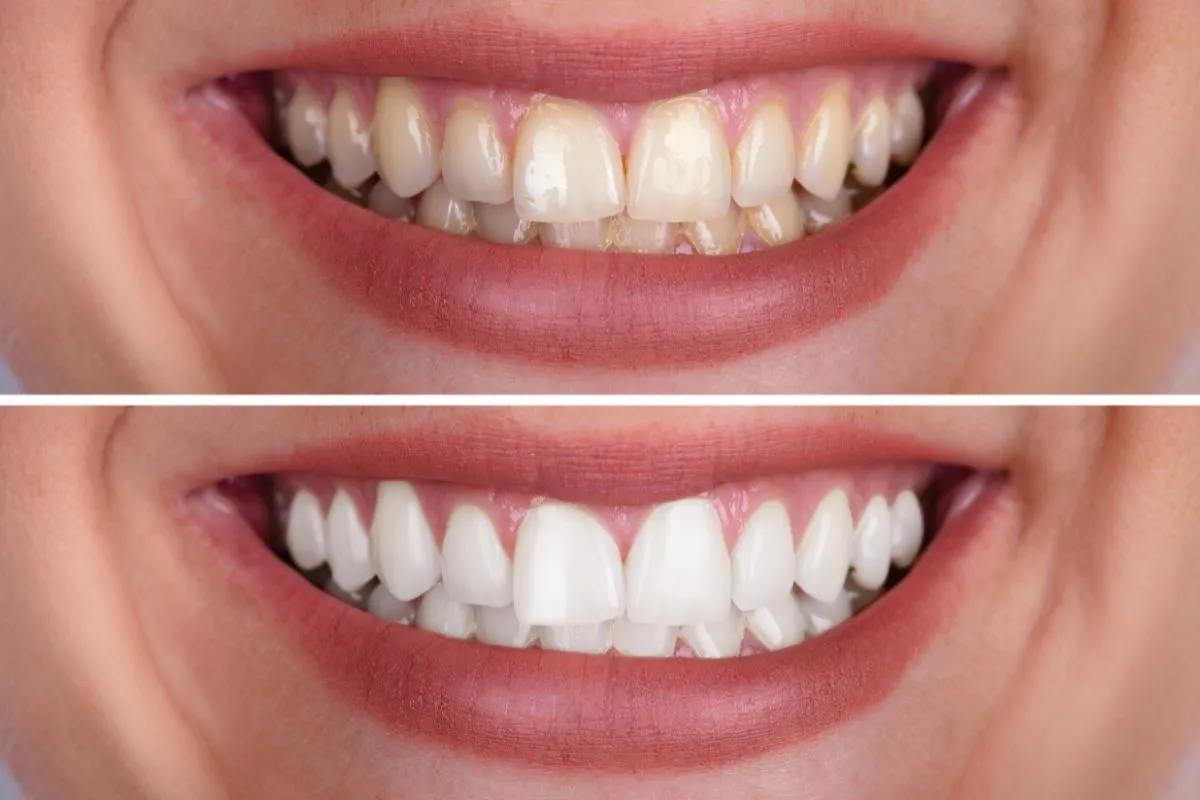24724 teeth sensitivity