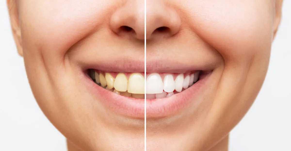 24724 tooth discoloration