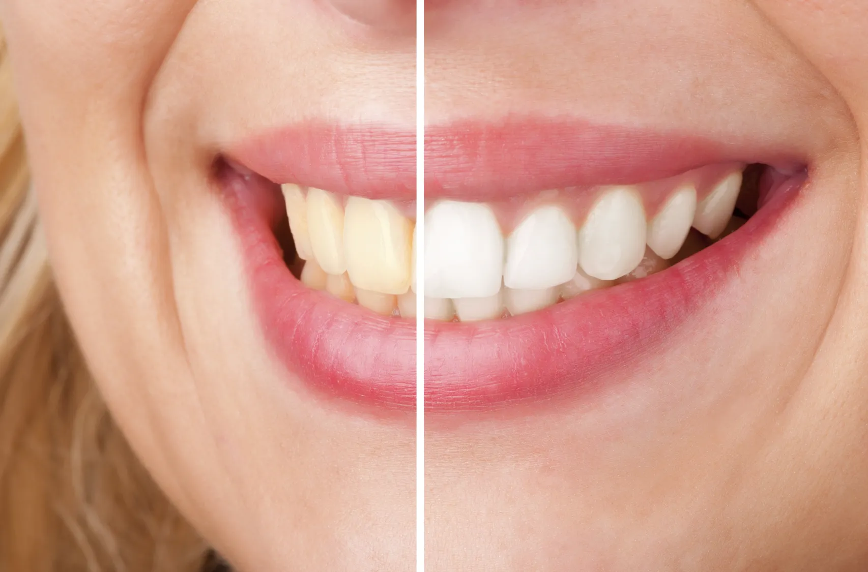 24724 tooth enamel