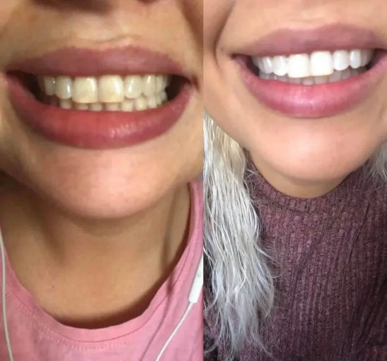 /img/24725-crest-whitening-strips-results.webp