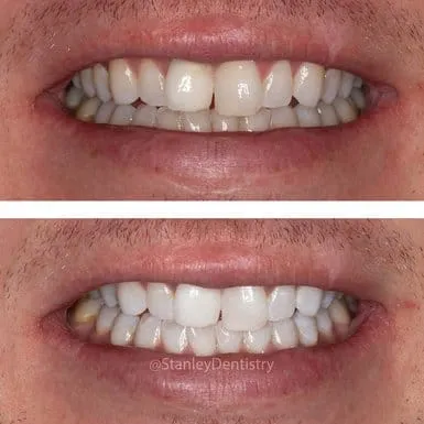 24728 kör whitening