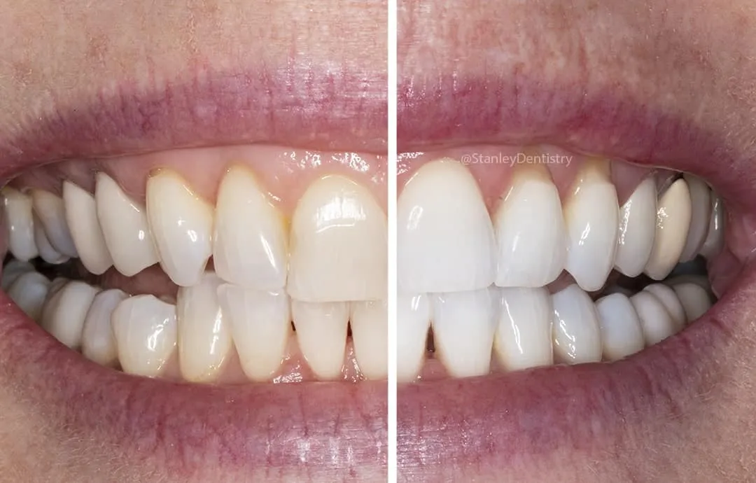 24728 teeth whitening comparison
