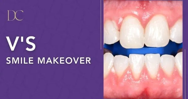 24728 zoom whitening