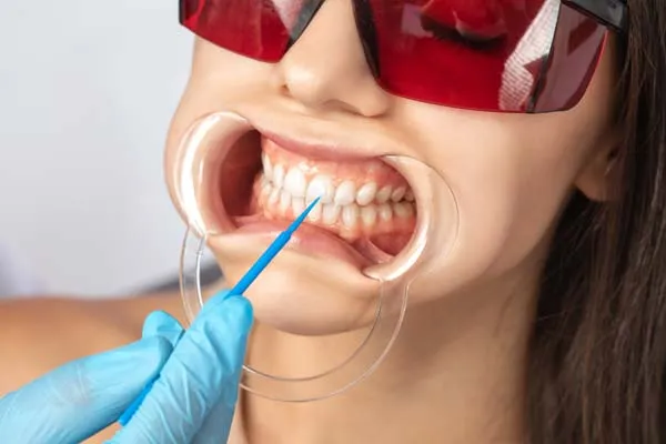 24729 katy tx teeth whitening avoid stains