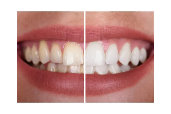 24729 katy tx teeth whitening dental checkup