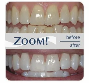 24729 katy tx teeth whitening diet