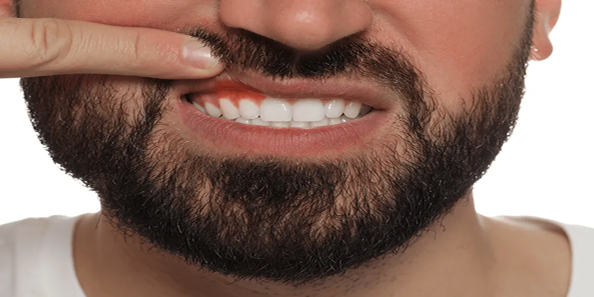 24734 charcoal teeth whitening