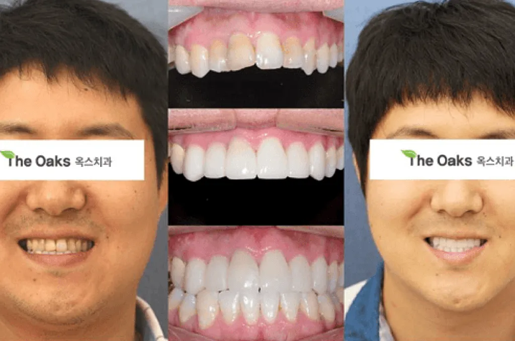 24735 sensitive teeth