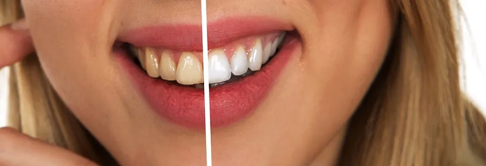 24735 teeth whitening aftercare