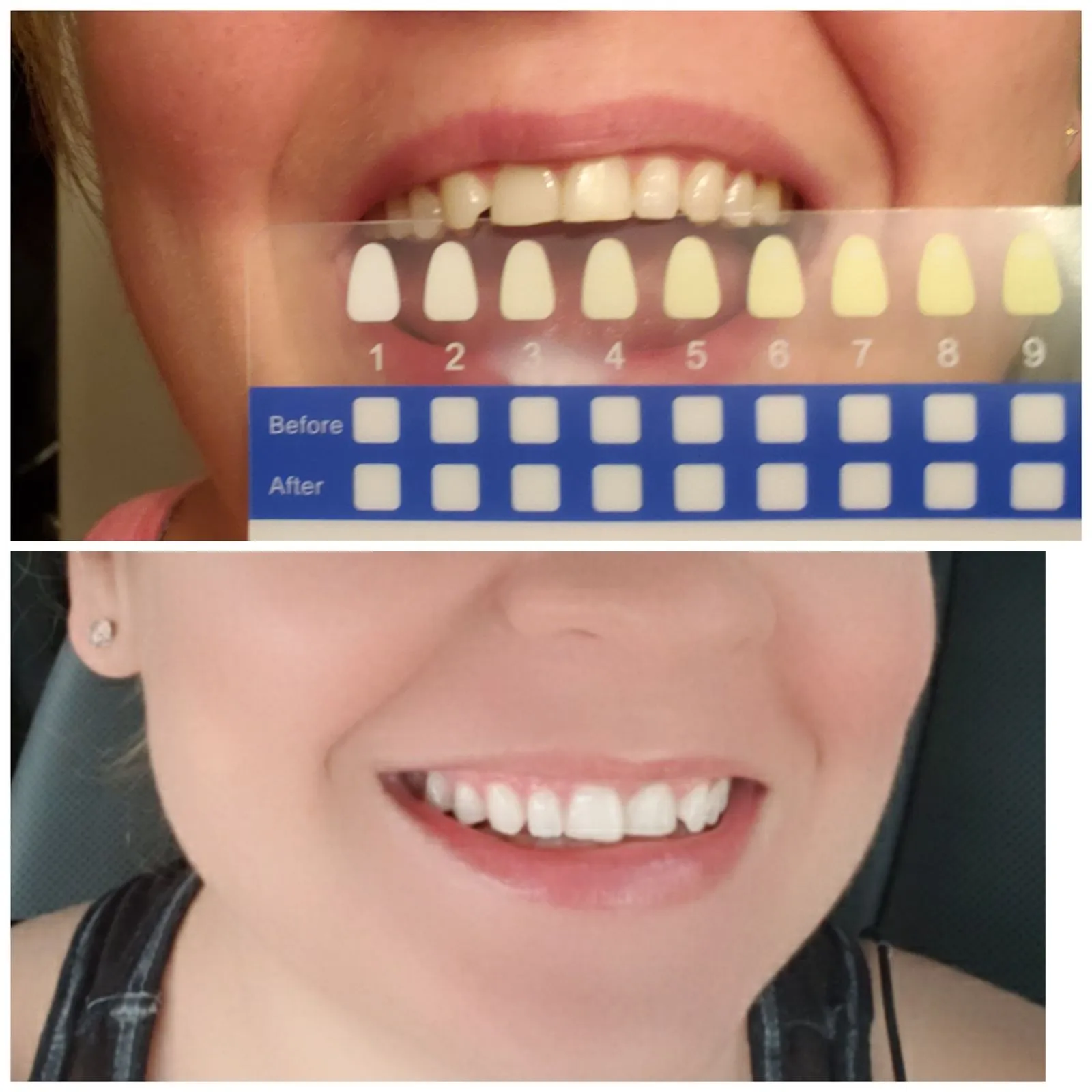 24737 post whitening care