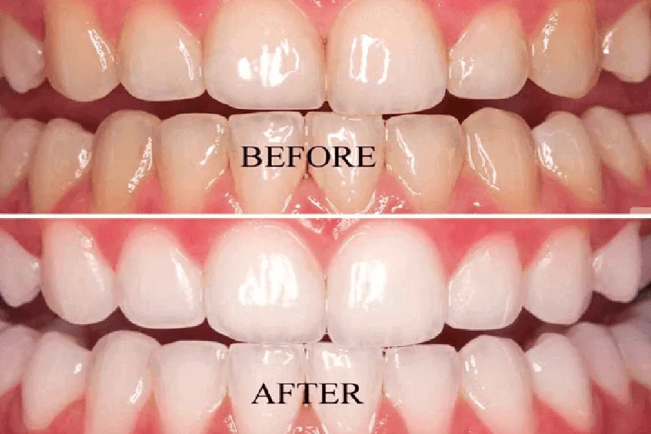 24739 whitening strip application