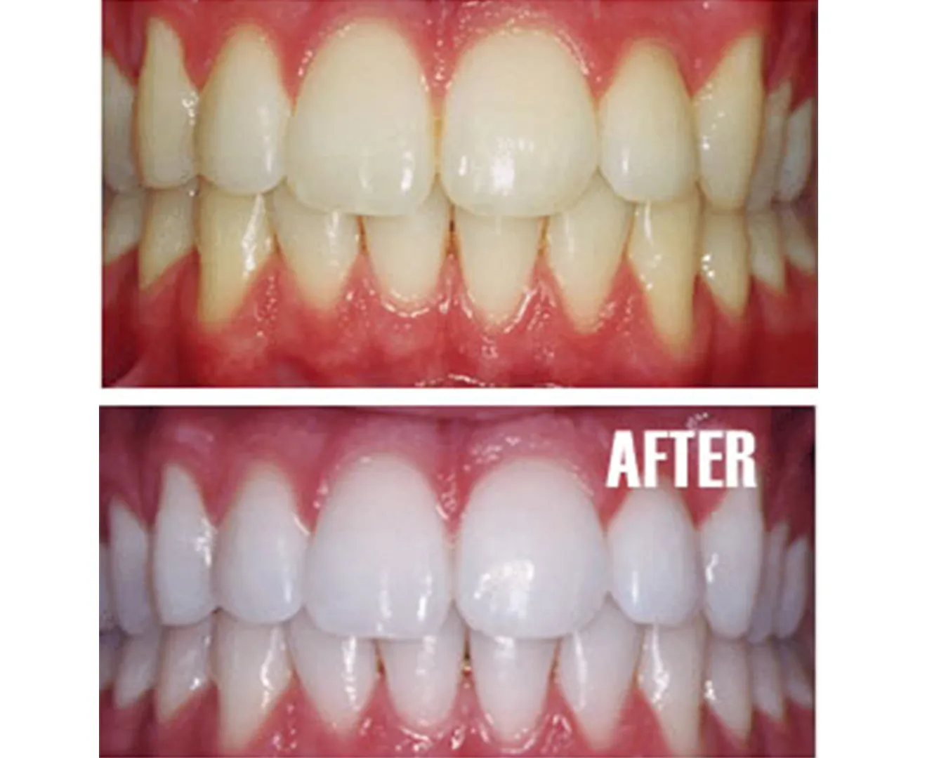 24740 understanding ice whitening