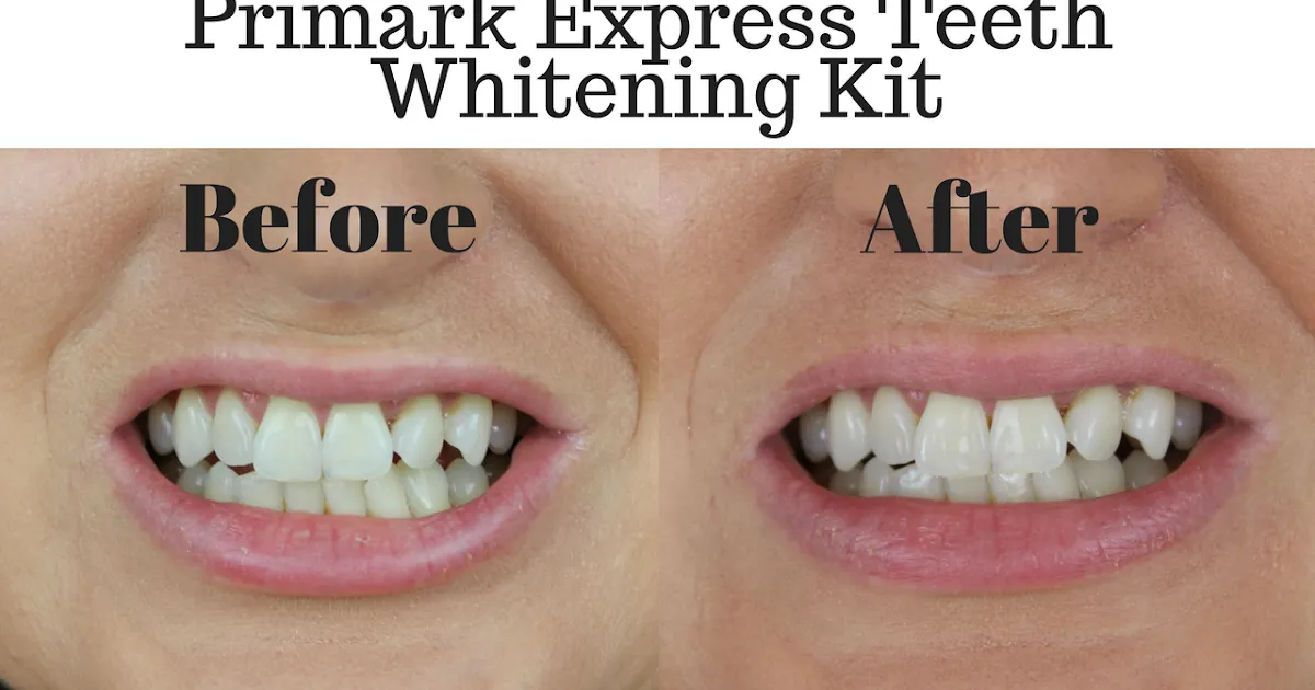 24741 in office teeth whitening
