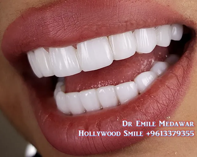24741 types of teeth whitening