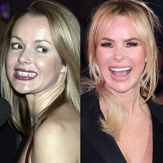 24742 celebrity teeth whitening transformation