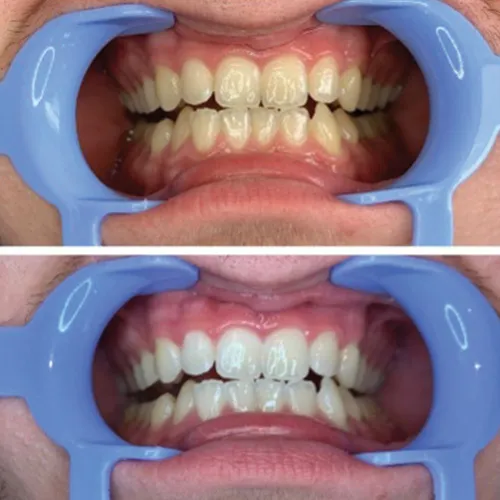 /img/24747-avoid-teeth-staining-foods.webp