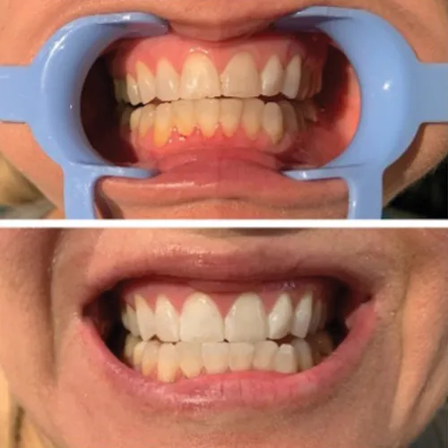 24747 maintaining white smile
