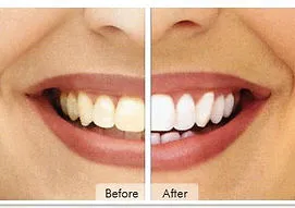 24747 provo teeth whitening before after
