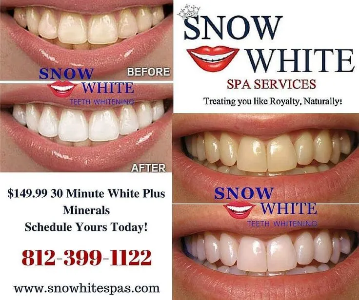 24747 teeth whitening procedure