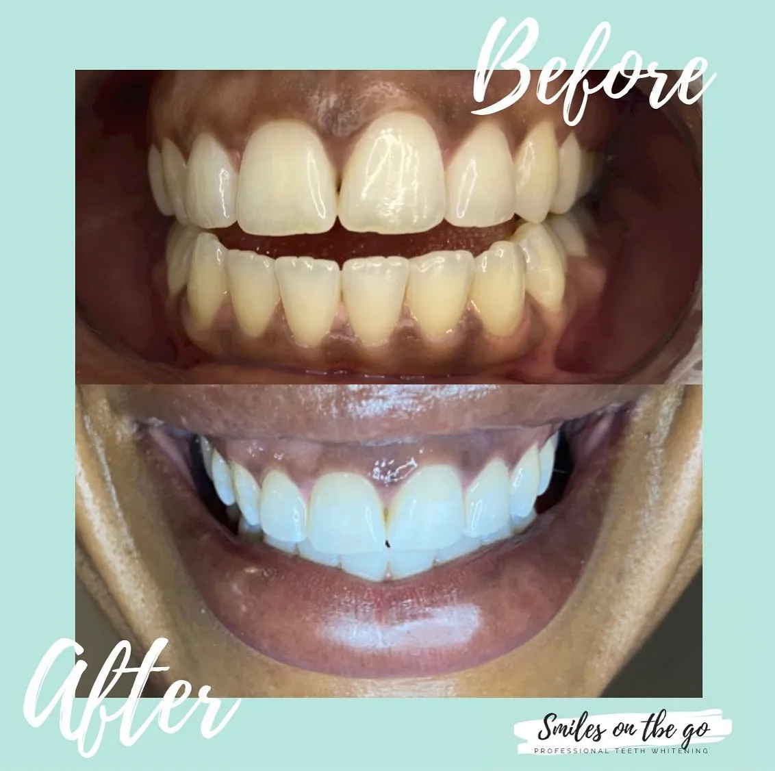 24748 smile lounge teeth whitening procedure