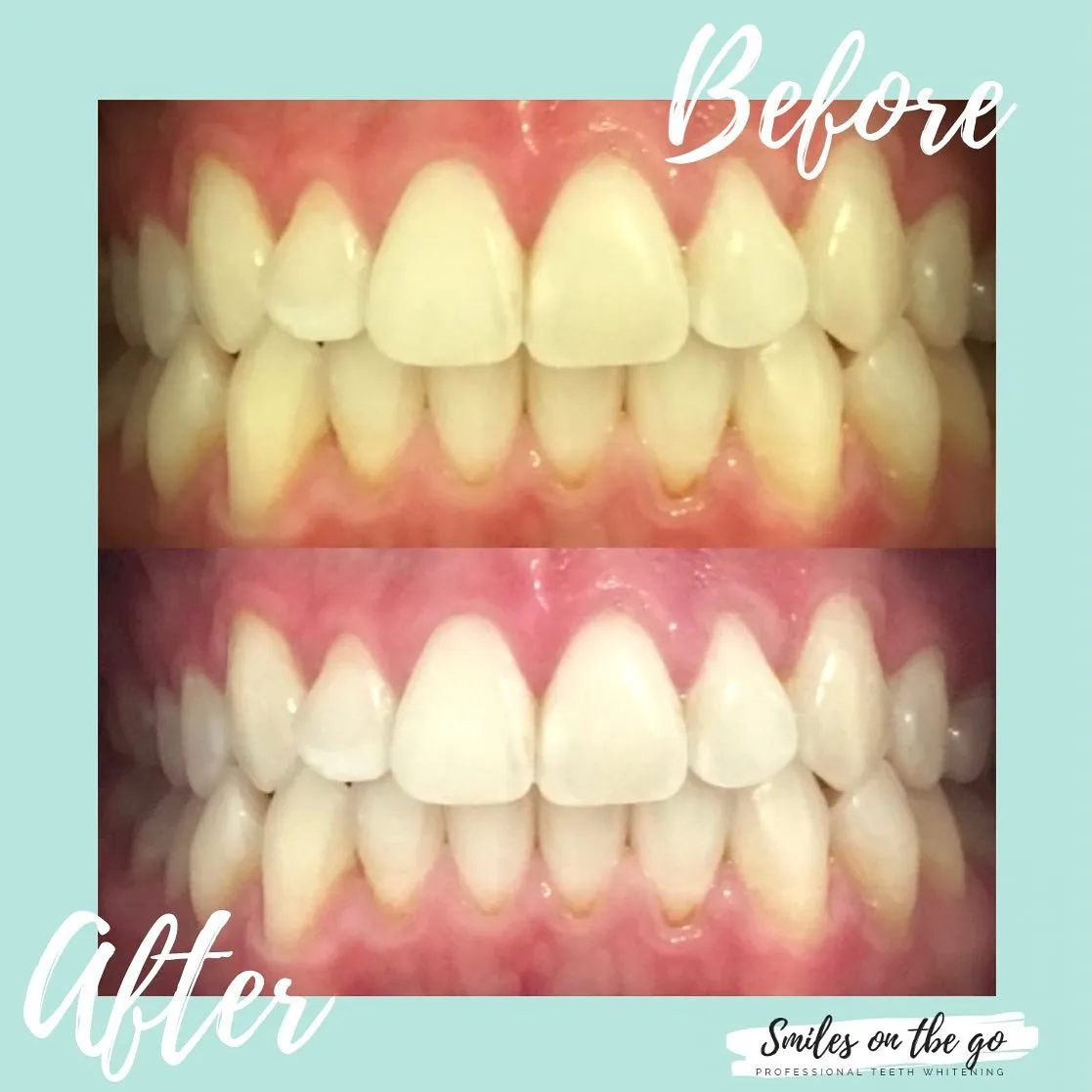 24748 smile lounge teeth whitening treatment
