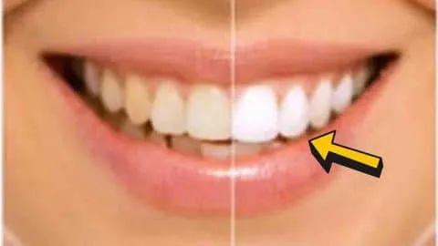 24750 teeth whitening 2