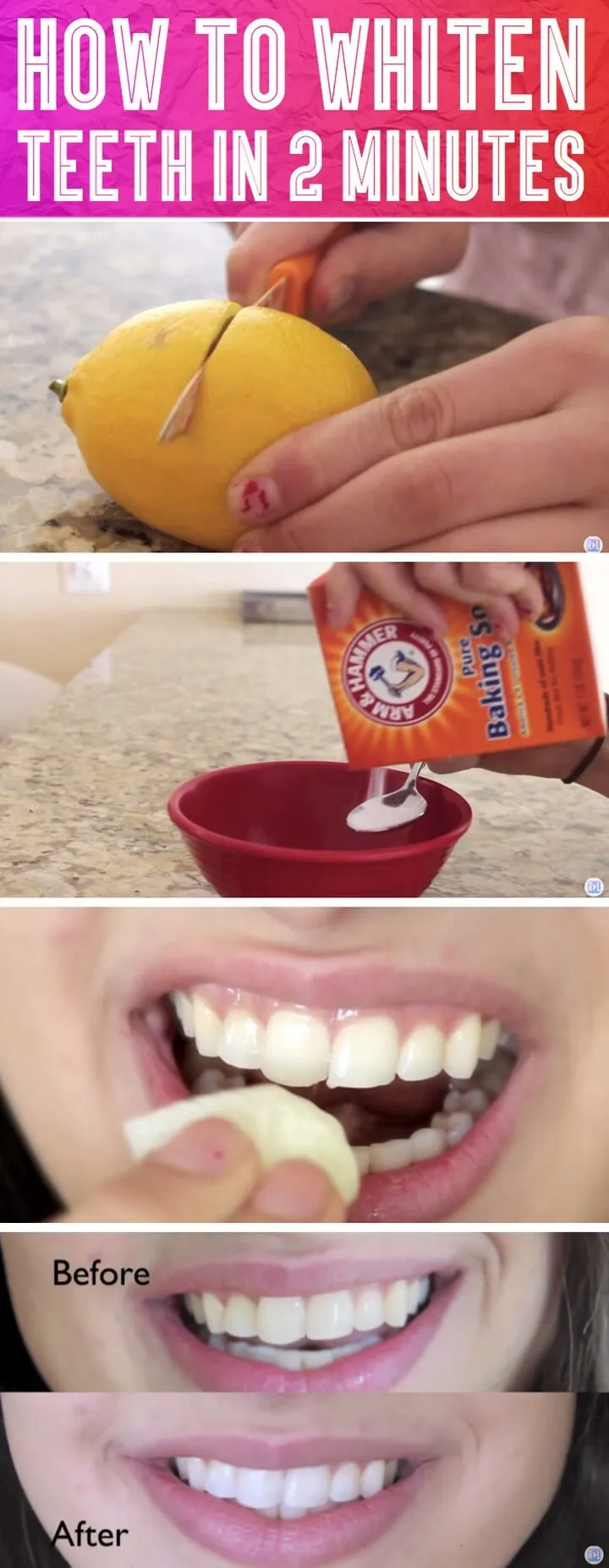 24750 teeth whitening 4