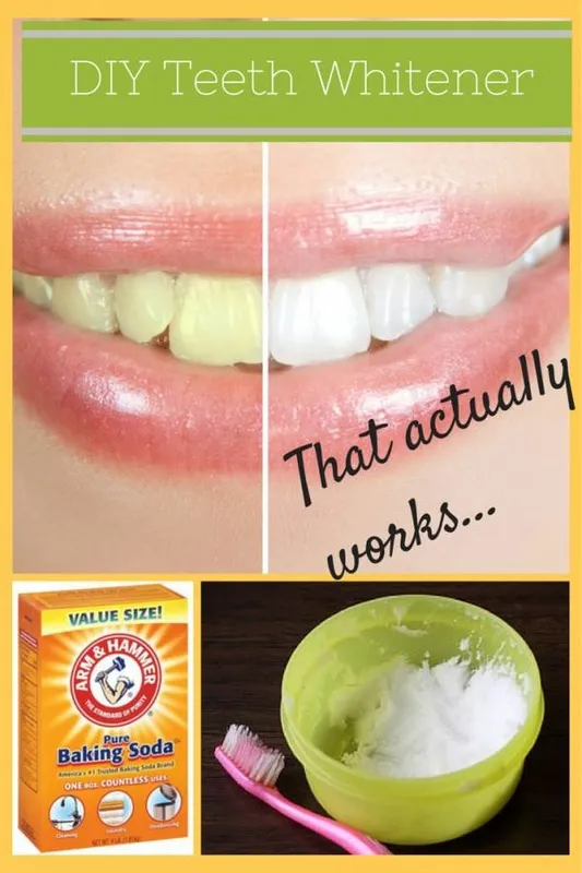 24750 teeth whitening 5