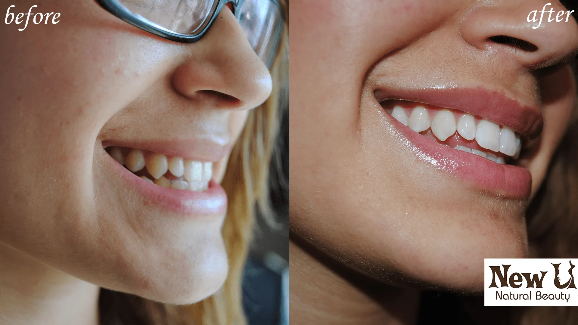 24752 teeth whitening professional cleaning