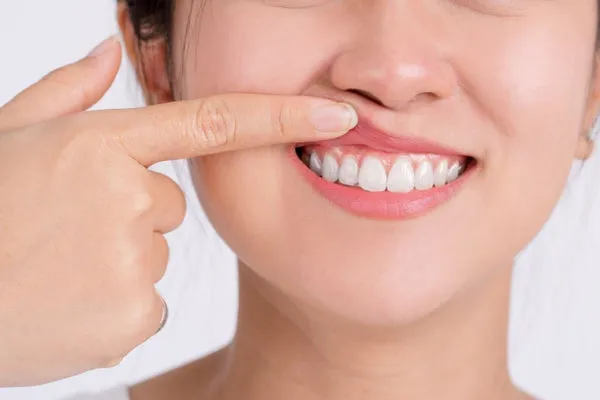 24759 dehydration gums