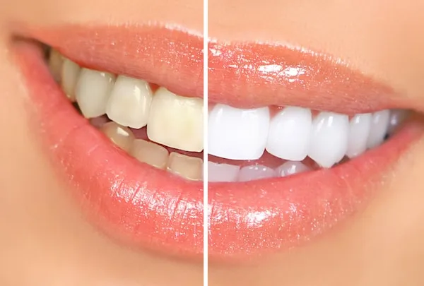 24762 sensitive teeth after whitening 1