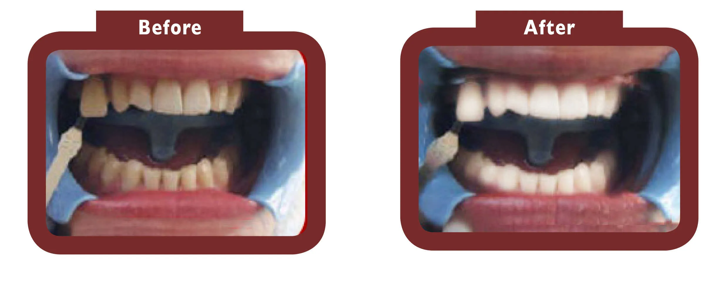 24763 teeth whitening diet