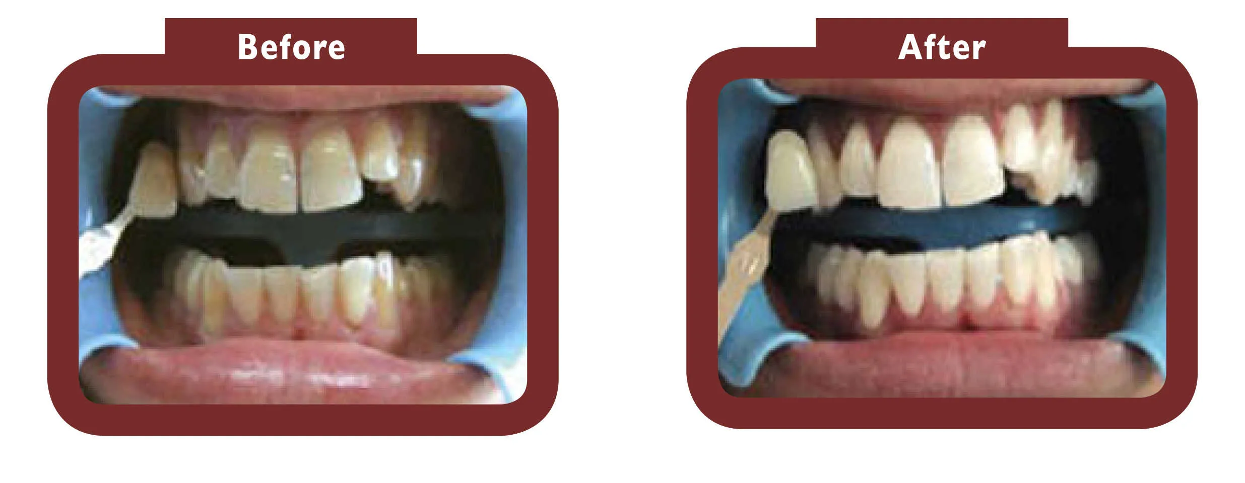 24763 teeth whitening lifestyle