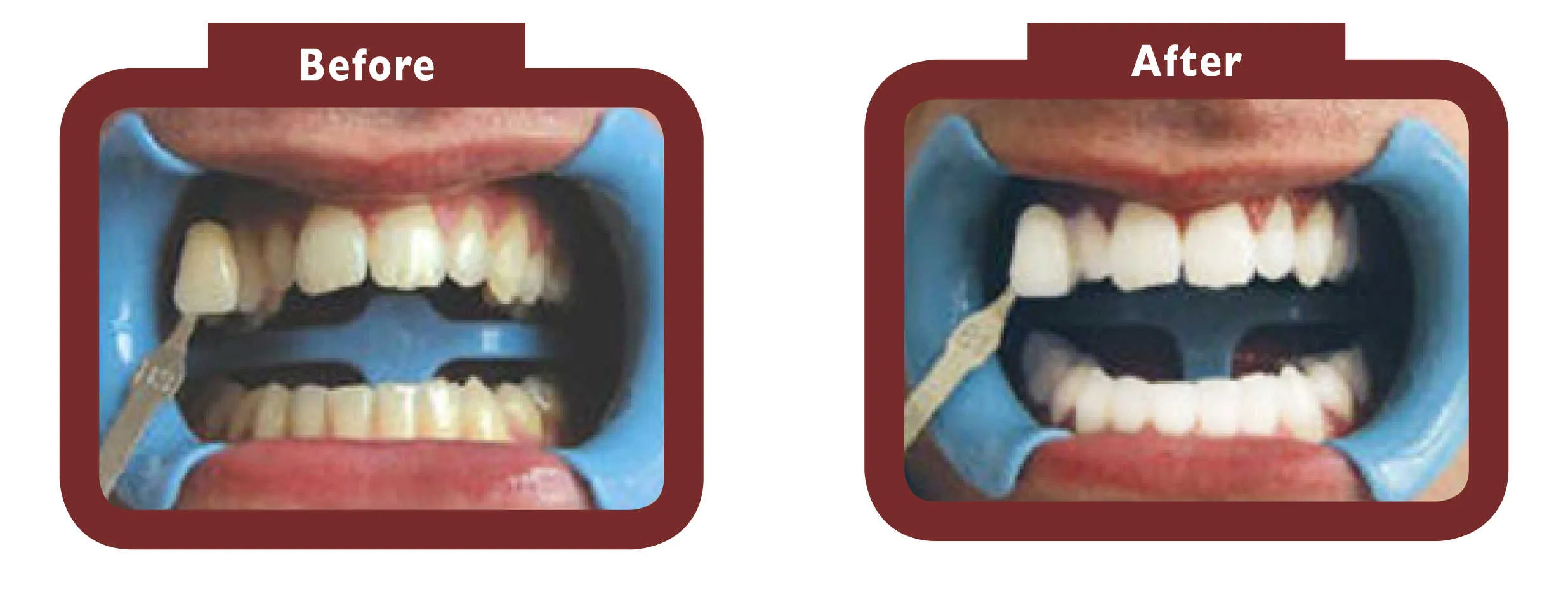 24763 teeth whitening maintenance