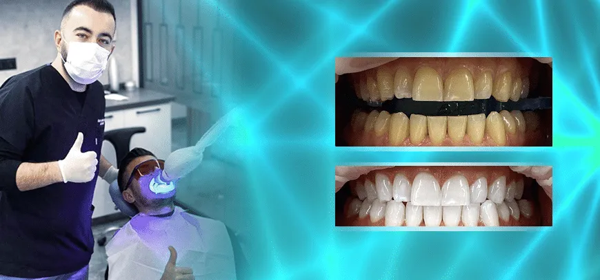 24766 akarui teeth whitening ingredients