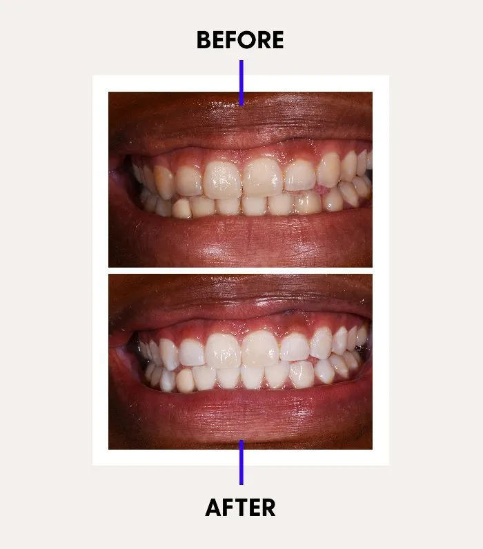 24766 teeth whitening before and after