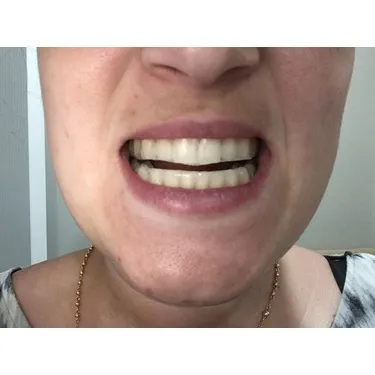 24769 equate ultra whitening strips application