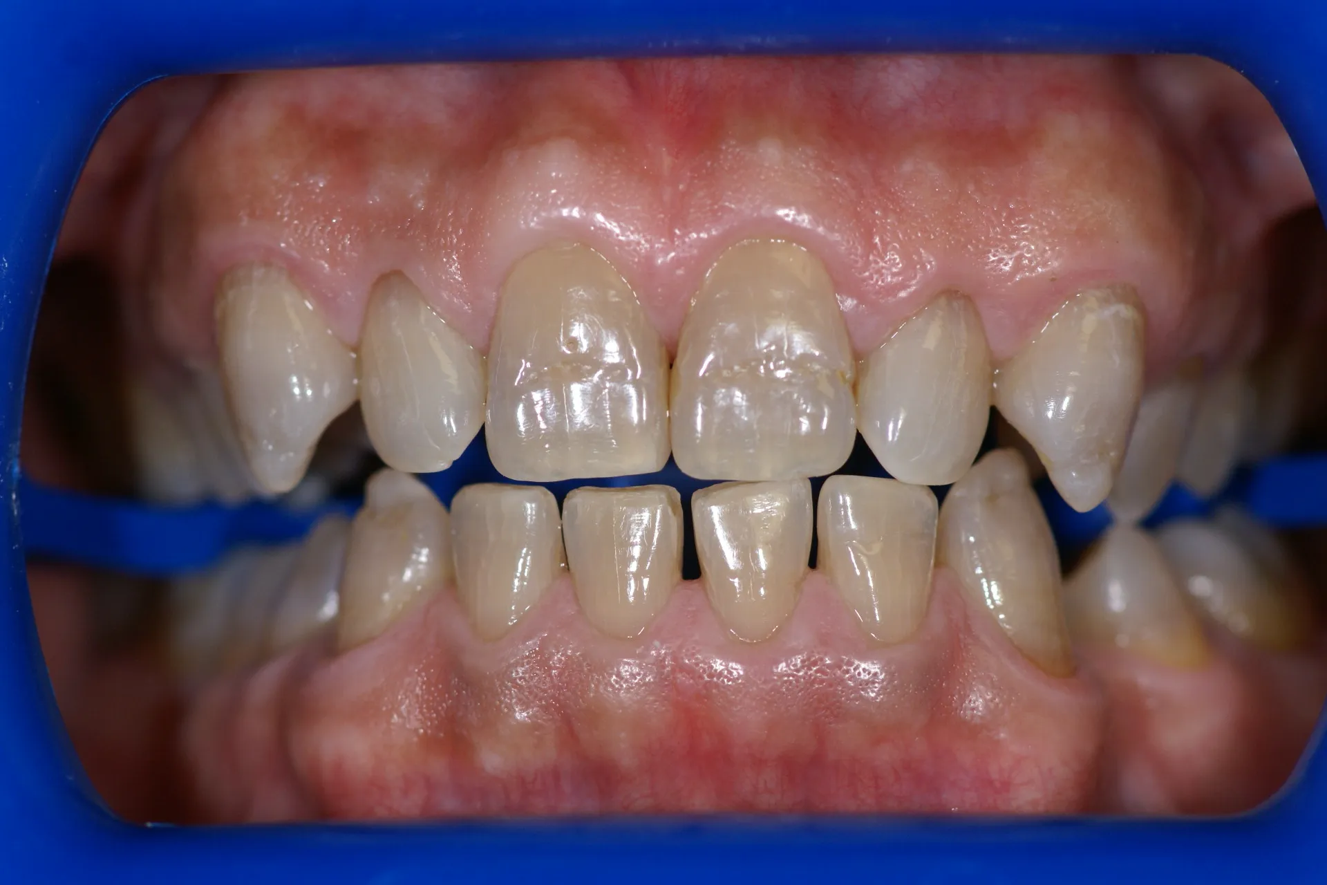 24771 protecting smile after whitening
