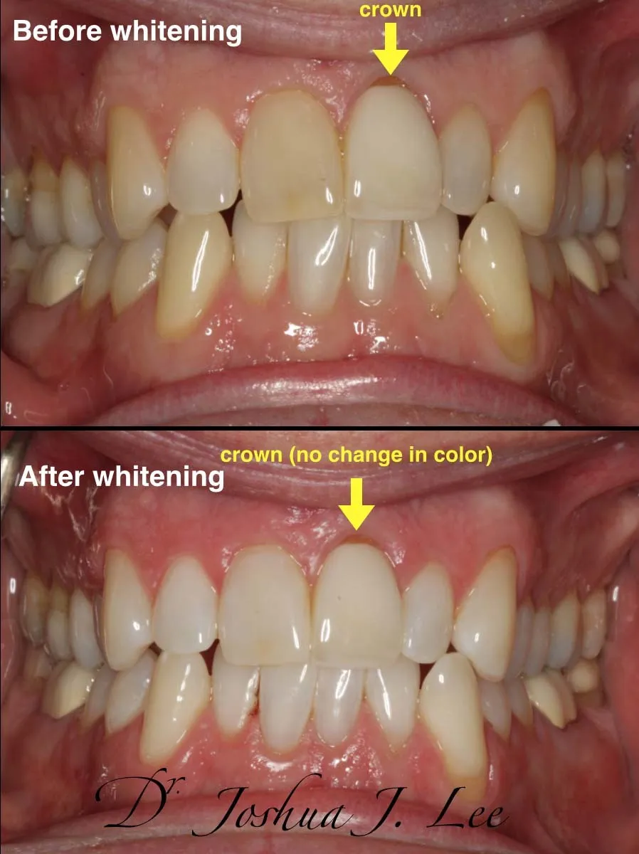 24771 zoom whitening procedure