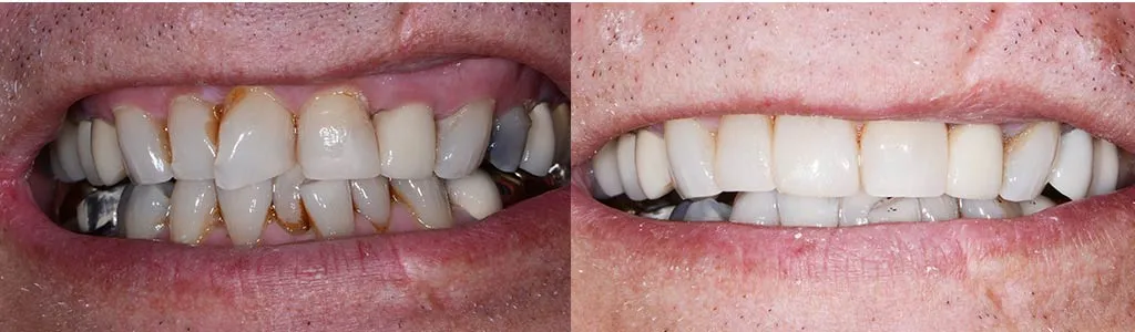 24774 whitening fillings front teeth 2