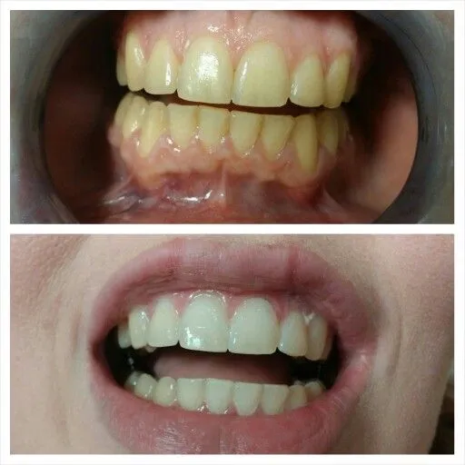 24774 whitening fillings front teeth 3