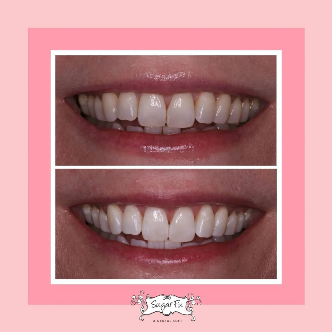 24774 whitening fillings front teeth 4