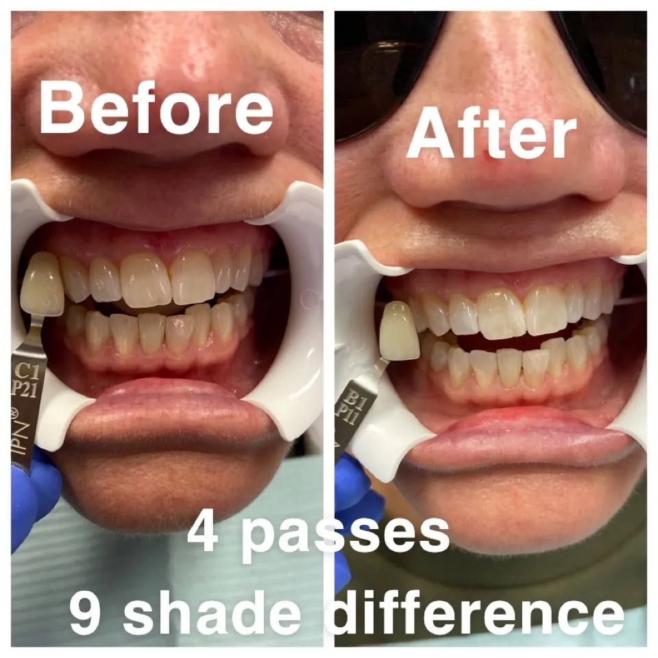 24774 whitening fillings front teeth 5