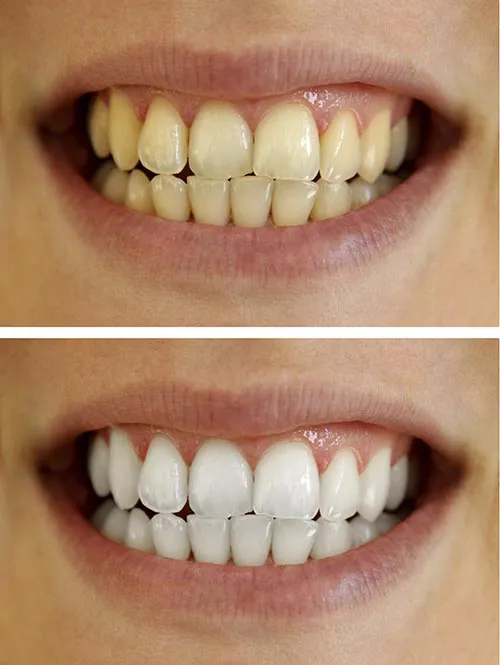 24775 before and after glo teeth whitening