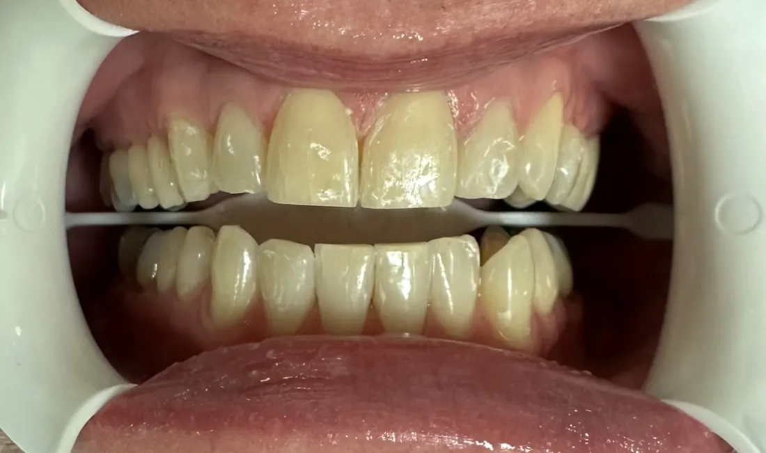 /img/24775-professional-teeth-whitening.webp