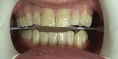 /img/24775-professional-teeth-whitening.webp