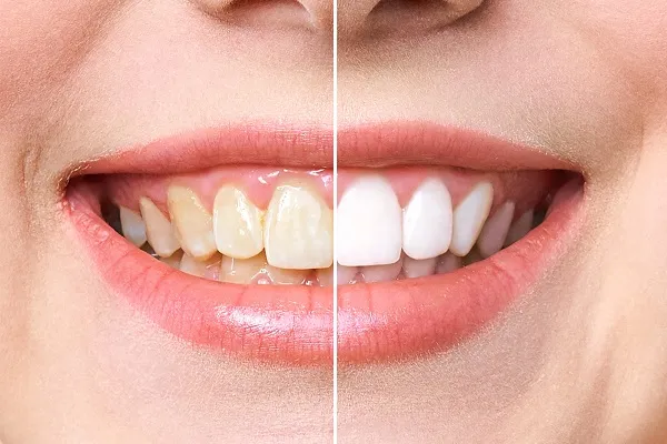 24775 teeth whitening gel