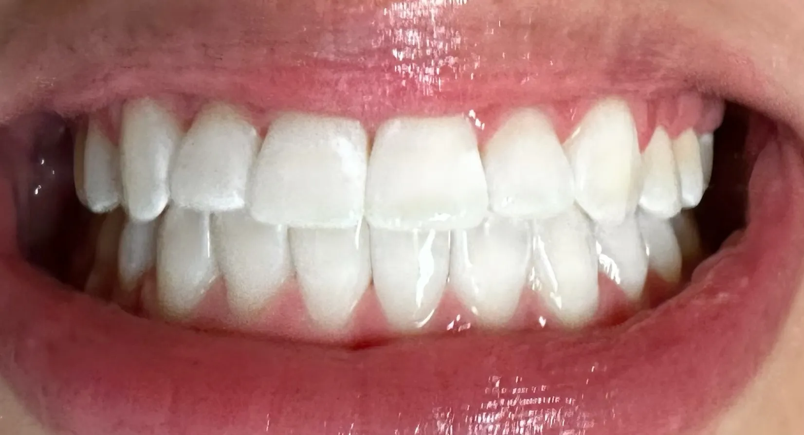24775 teeth whitening sensitivity